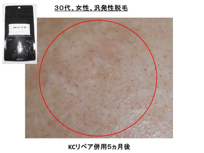 円形脱毛症　病院